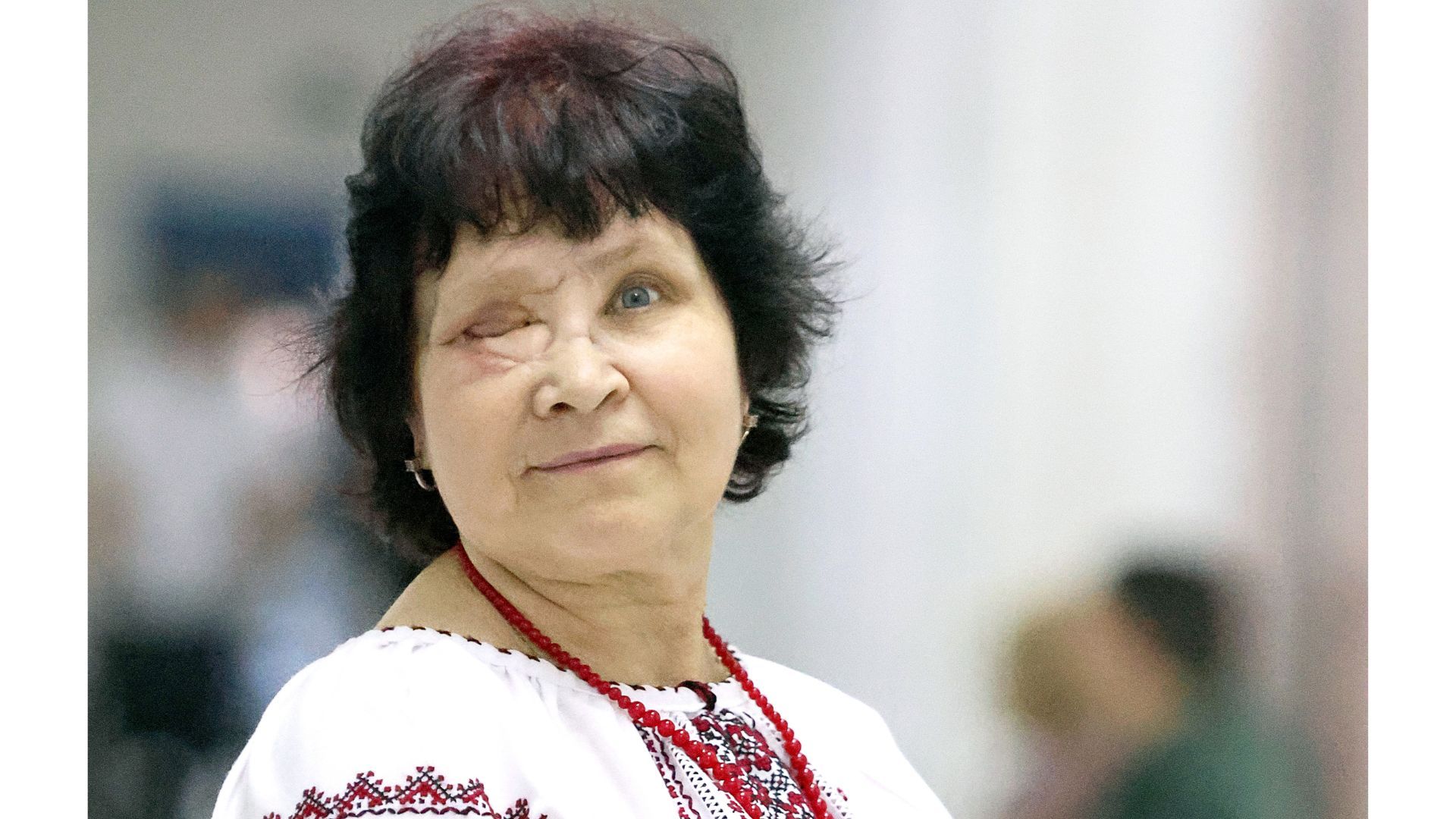 Олена Світлона, пацієнтка проекту «Незломлена краса».